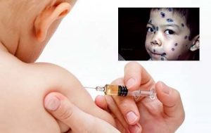 Vắc xin thủy đậu Varivax (Mỹ) công dụng