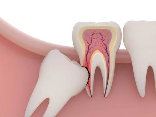 Thường răng khôn mọc lệch nhưng không đau có nên nhổ