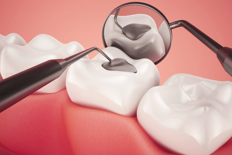 Sau khi trám răng rồi có bị sâu lại không?