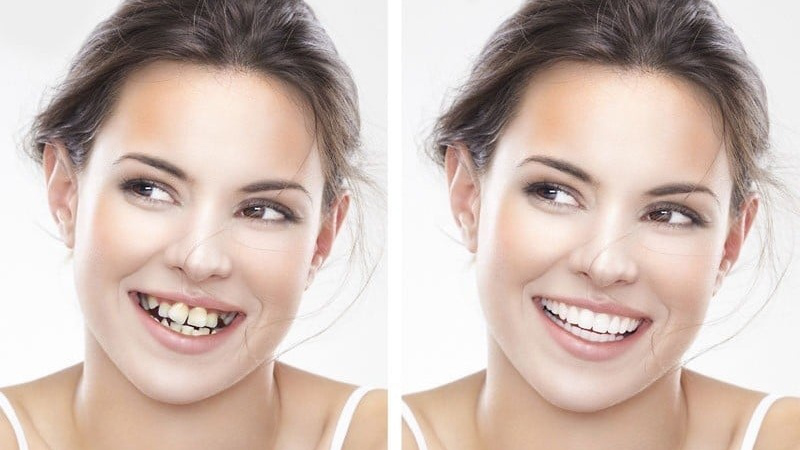 Những thay đổi sau khi niềng răng là gì