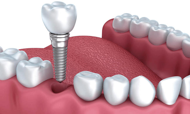 Nên trồng răng implant ở đâu tốt tphcm? Tham khảo trồng răng implant tại nha khoa park way HCM