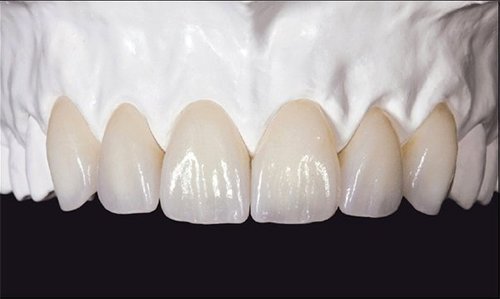 Có nên bọc răng sứ Zirconia?