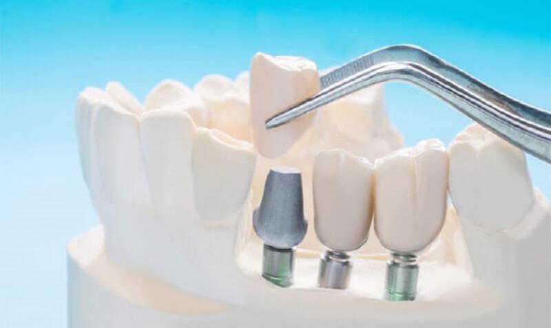 Nên trồng răng implant ở đâu tốt tphcm? Tham khảo trồng răng implant tại nha khoa park way HCM