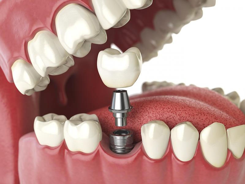 Nên trồng răng implant ở đâu tốt tphcm? Tham khảo trồng răng implant tại nha khoa park way HCM